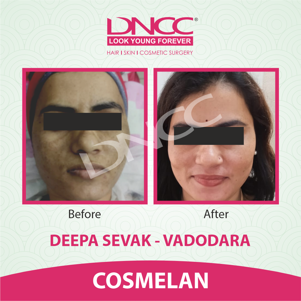 Hair Transplant Transformation 1